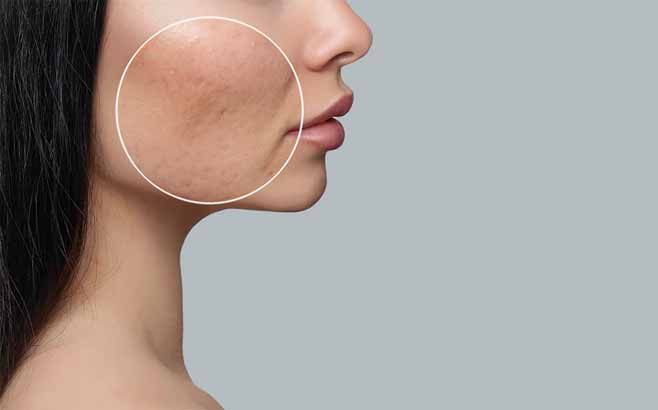 جراحی پلاستیک صورت جای جوش