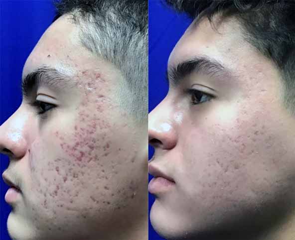 جای جوش | جراحی پلاستیک | صورت