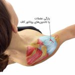 پارگی تاندون شانه | درمان بدون جراحی | نکات