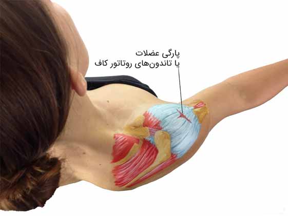درمان پارگی تاندون شانه بدون جراحی