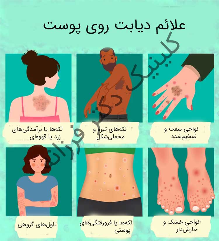 علایم دیابت روی پوست
