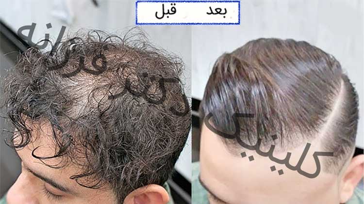 کراتین موی کوتاه کم پشت