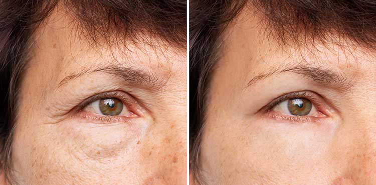 بلفاروپلاستی