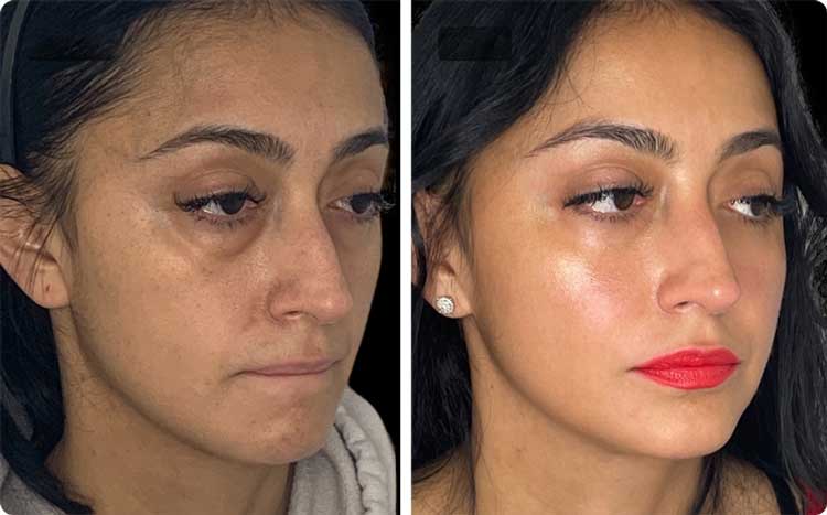 انتقال چربی صورت