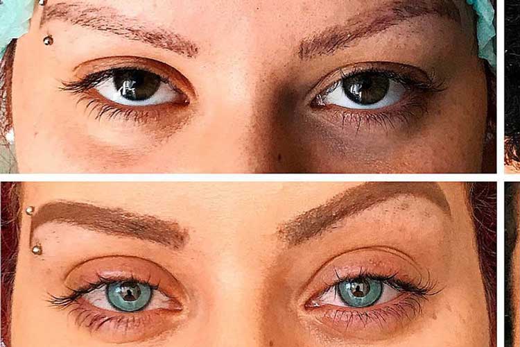 جراحی تغییر رنگ چشم