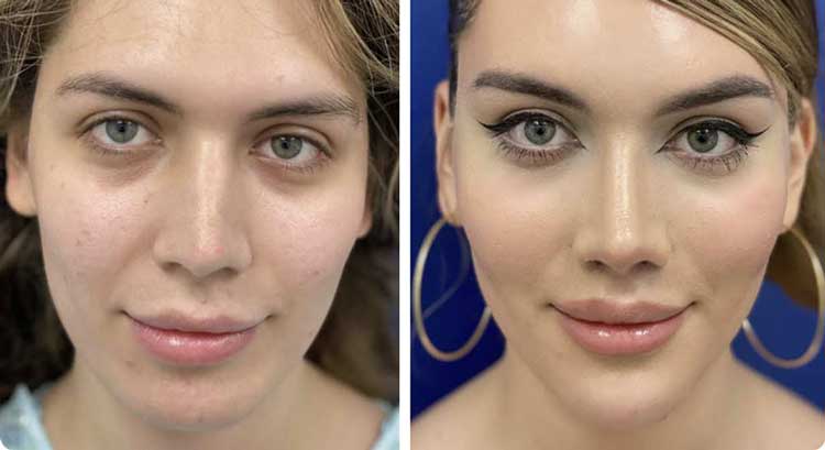 عمل زیبایی کل صورت