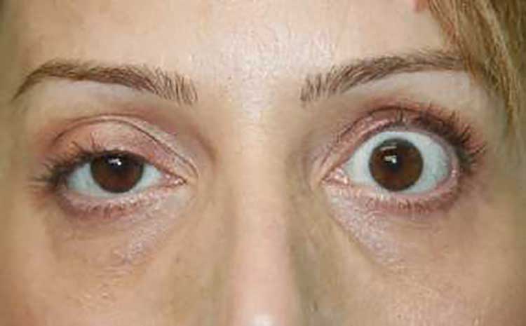 افتادگی پلک