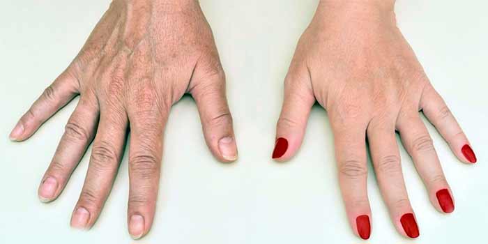 جراحی تزریق فیلر به پشت دست (Hand Filler Injection)