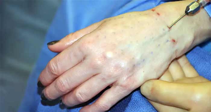 جراحی تزریق چربی (Fat Grafting) به دست