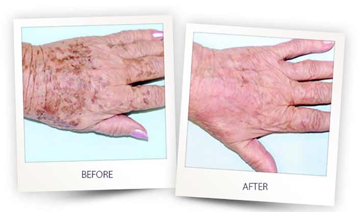 جراحی درمان لک و رگهای دست با لیزر و IPL