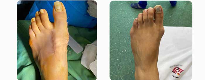 جراحی جراحی اصلاح بونیون (Bunionectomy) – هالوکس والگوس