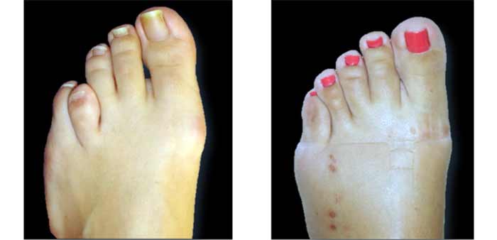 جراحی کوتاه کردن یا بلند کردن انگشتان پا (Toe Shortening/Lenghtening)