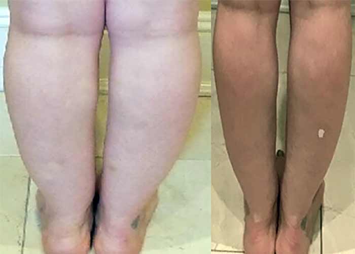 جراحی باریک کردن مچ و ساق پا (Ankle & Calf Liposuction)