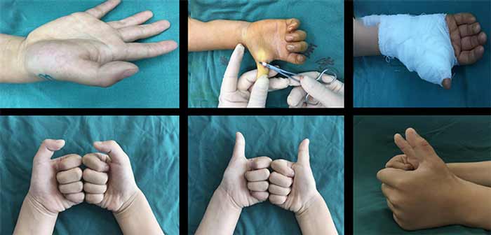 جراحی زیبایی انگشت شست دست: هزینه و نکات