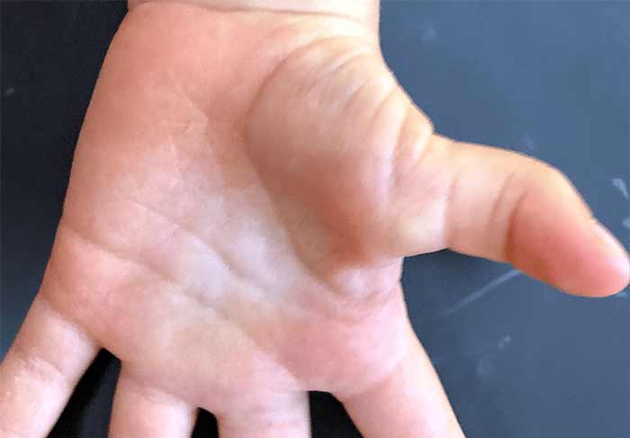 انگشت ماشه‌ای