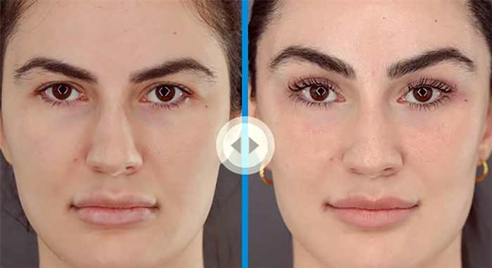 اصلاح صورت با فیلر و بوتاکس 