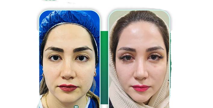 جراحی پلک