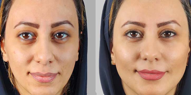 تزریق چربی به صورت