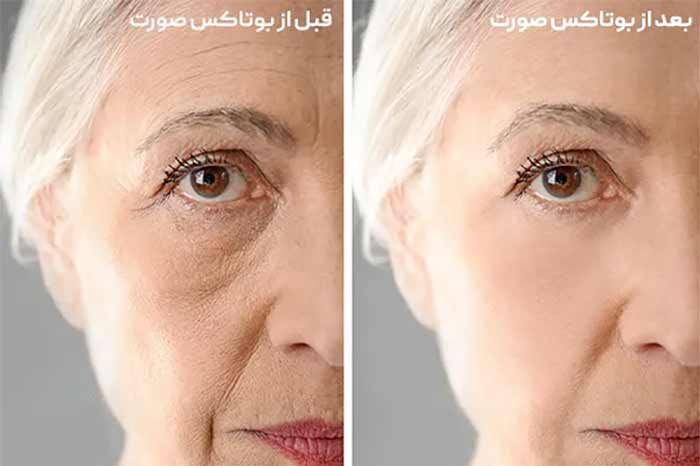 بعد از بوتاکس صورت /قبل از بوتاکس صورت 