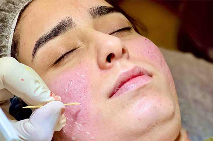پاکسازی پوست 