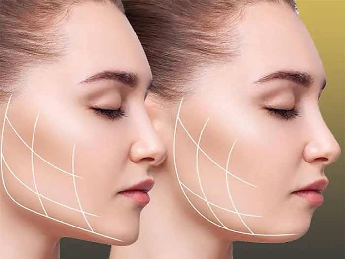 جراحی زیبایی لیپوساکشن غبغب